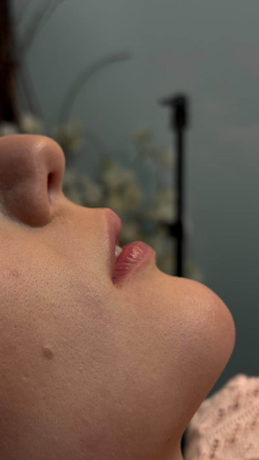 Antes do preenchimento labial