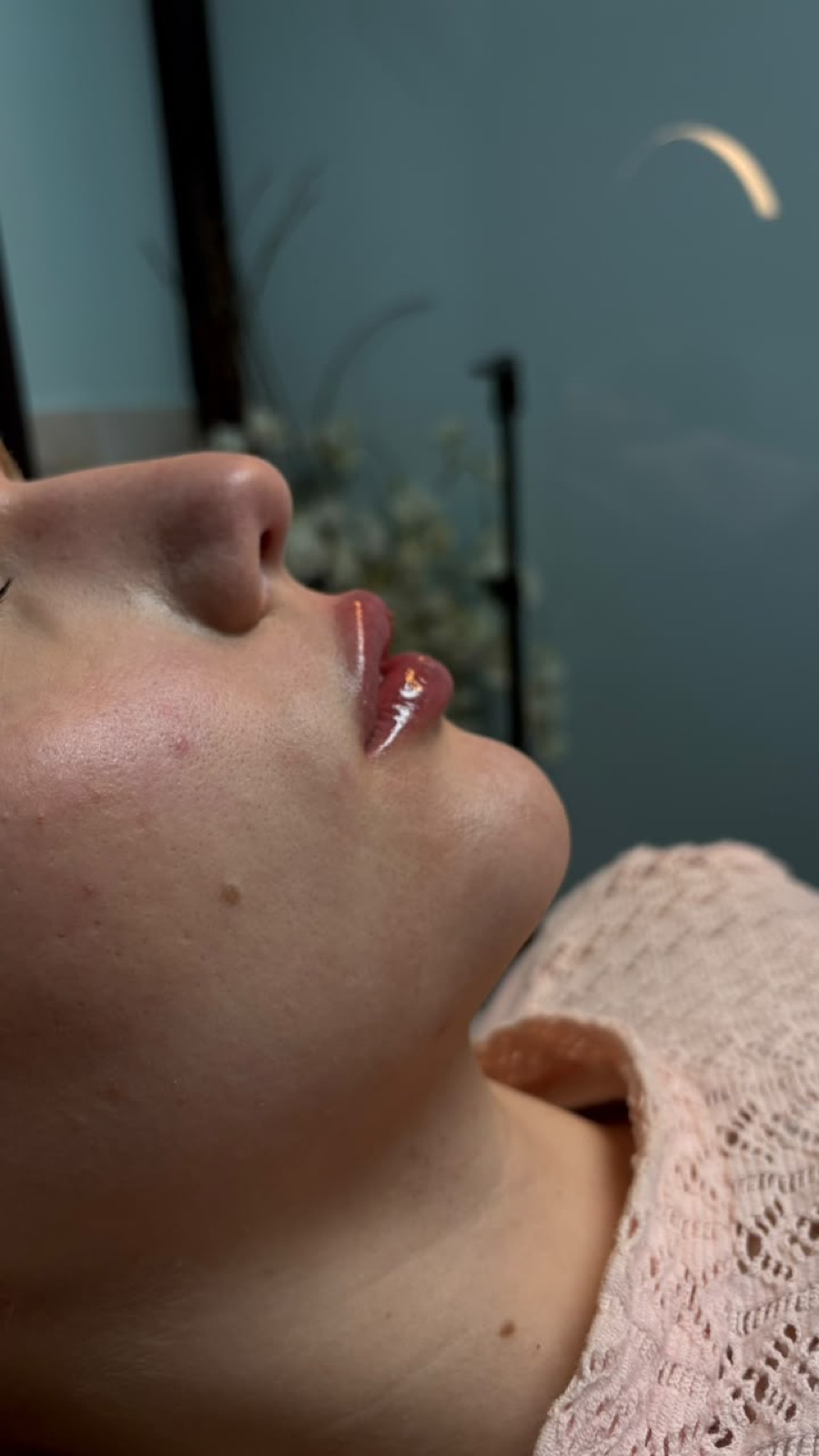 Depois do preenchimento labial