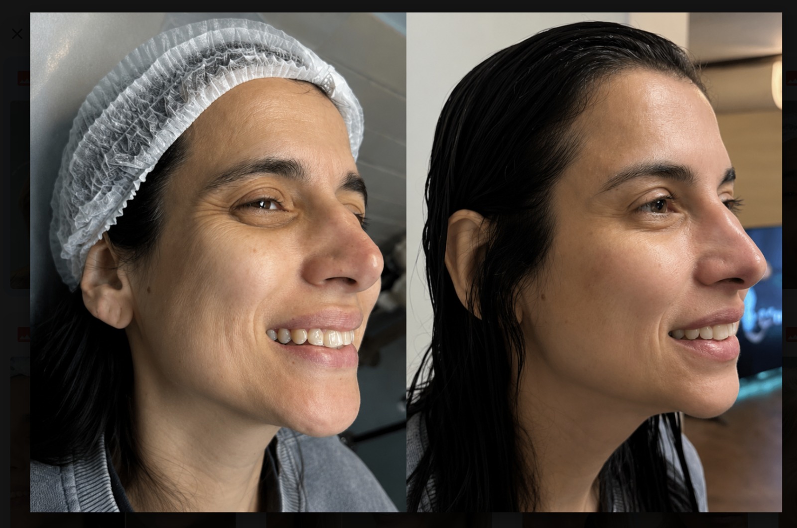 Antes e depois — Botox