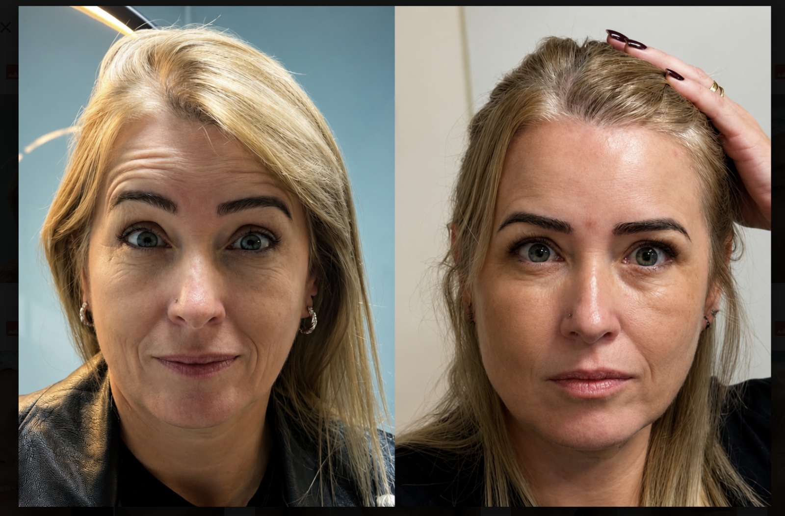 Antes e depois — Botox
