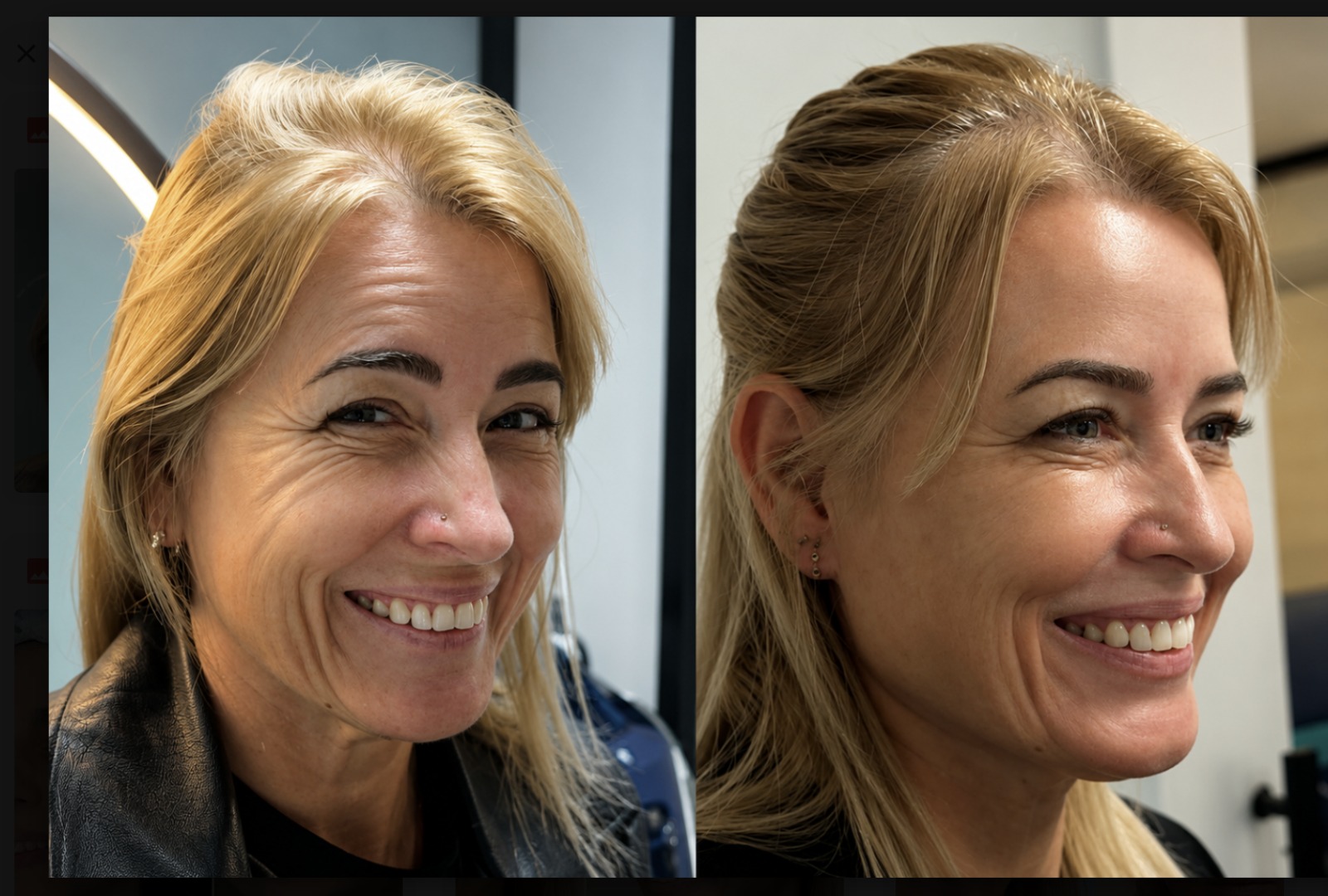 Antes e depois — Botox
