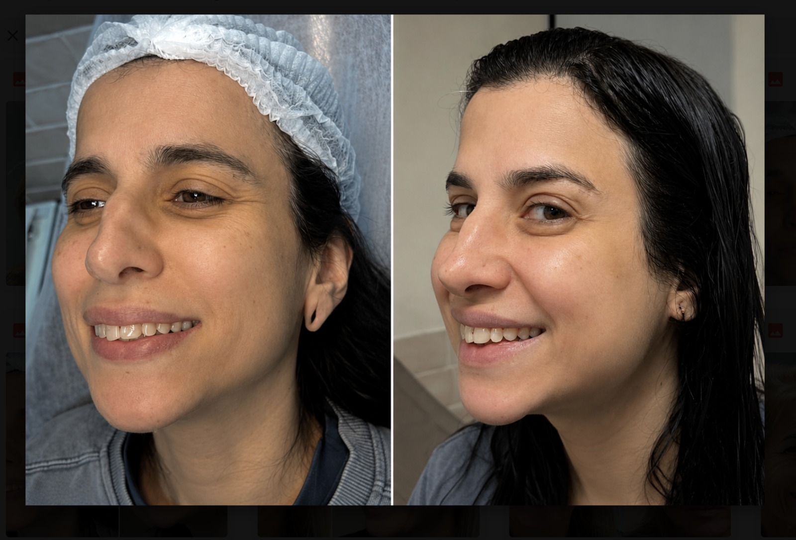 Antes e depois — Botox