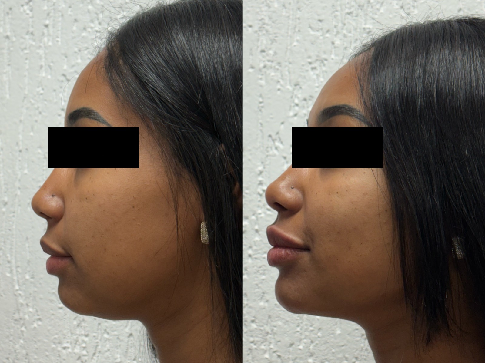 Antes e depois — harmonização facial