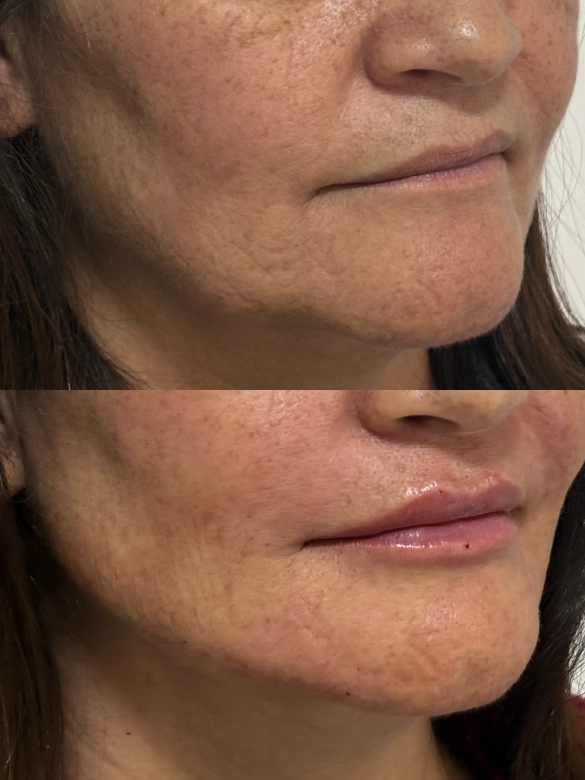 Antes e depois — harmonização facial