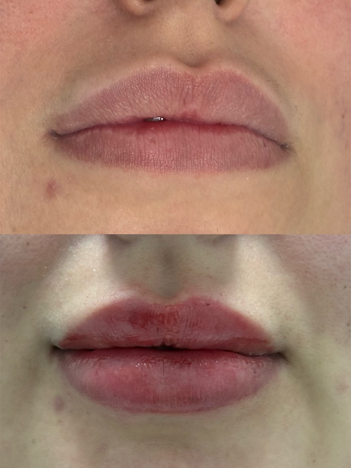 Resultado preenchimento labial