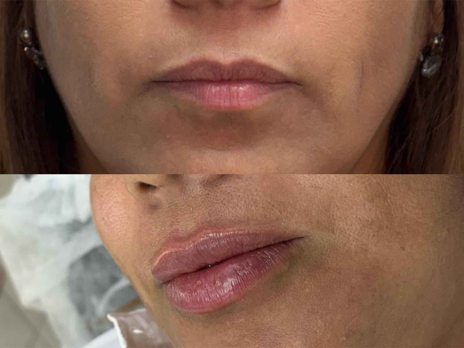 Resultado preenchimento labial