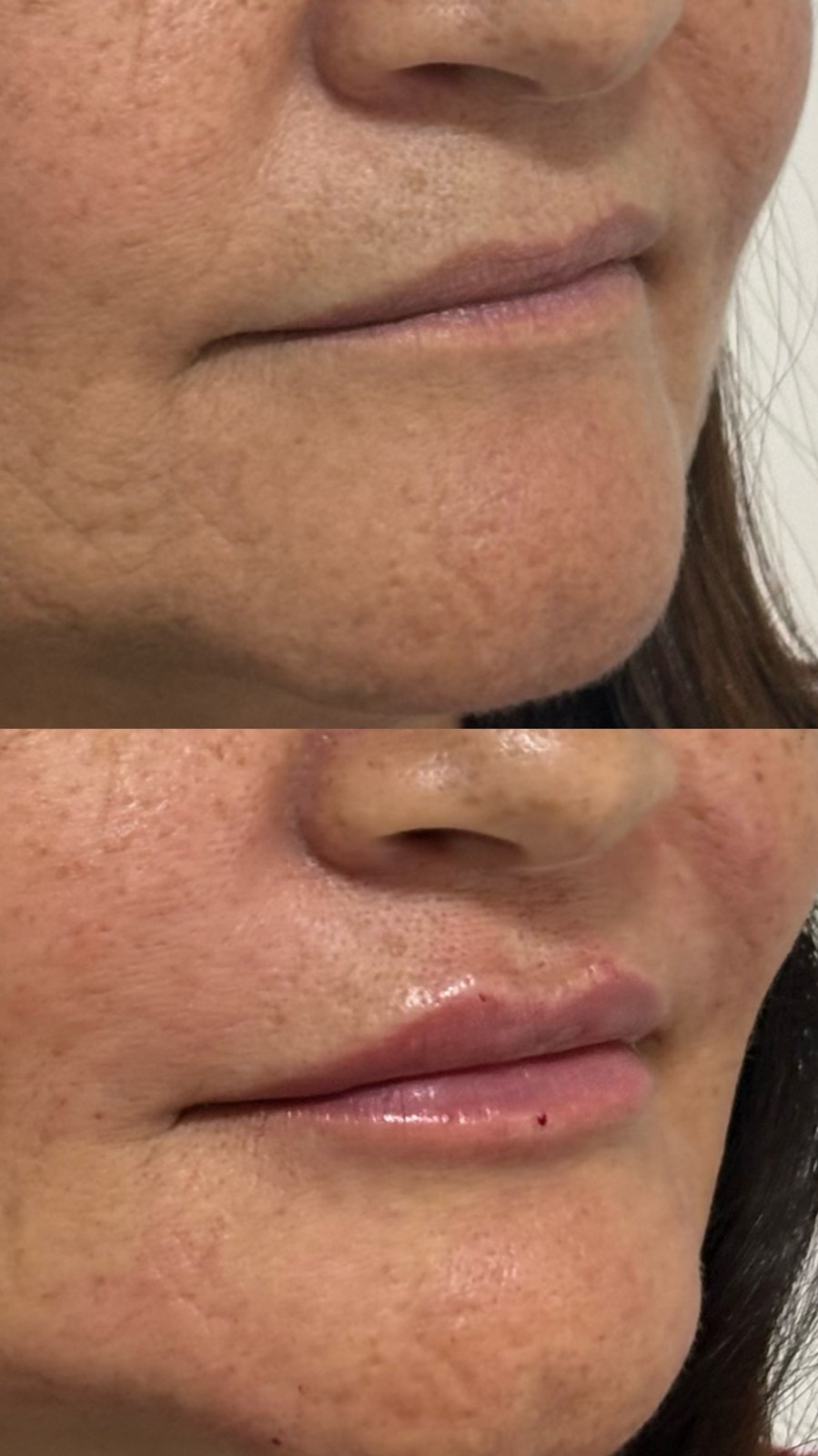 Resultado preenchimento labial
